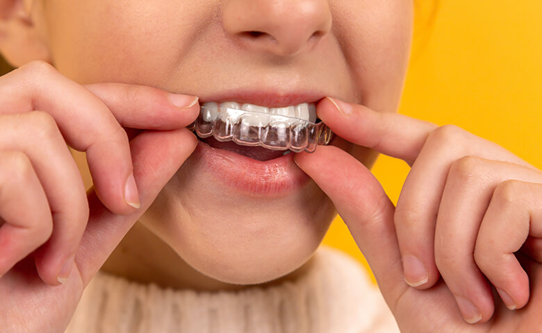 Invisalign Setup
